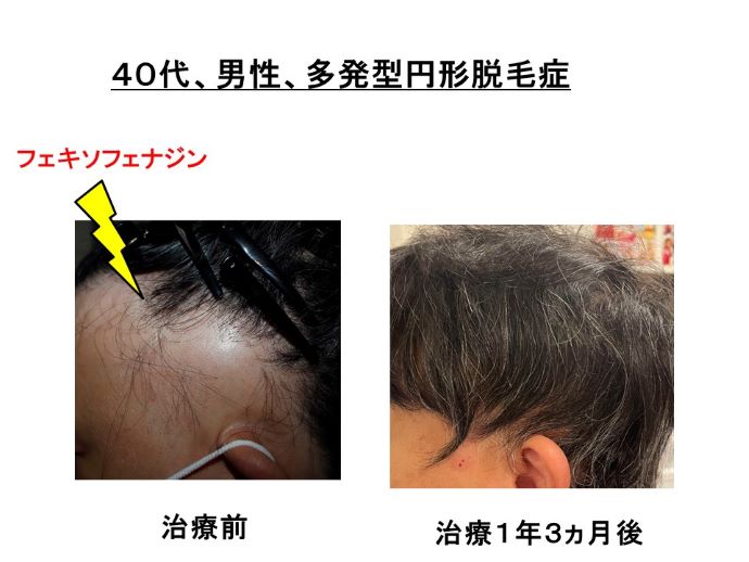 円形脱毛症　病院